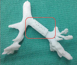 3D Printed Airway Splint Saves Babys Life