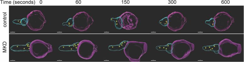 3D Video Frames of an MKD Patient&rsquo;s Impaired NK Cells