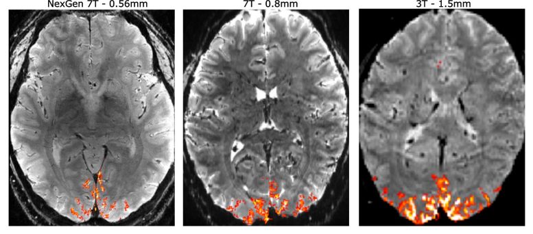 3T, 7T and NexGen 7T Brain Imaging Comparison