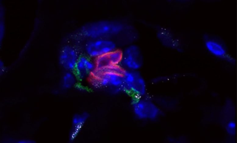 A Nest of Dormant Cancer Cells in the Bone