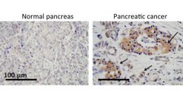 A New Target for Attacking Pancreatic Cancer