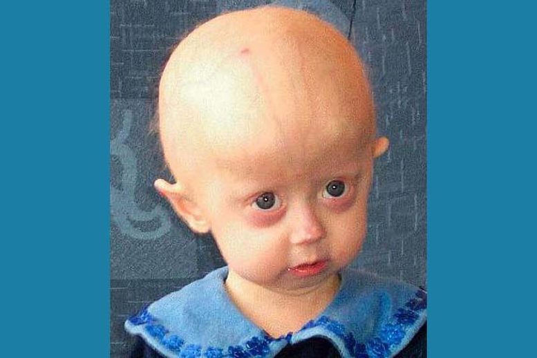 A Young Girl With Progeria