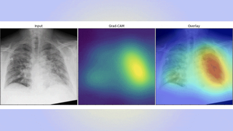AI Detects COVID-19 Chest X-ray
