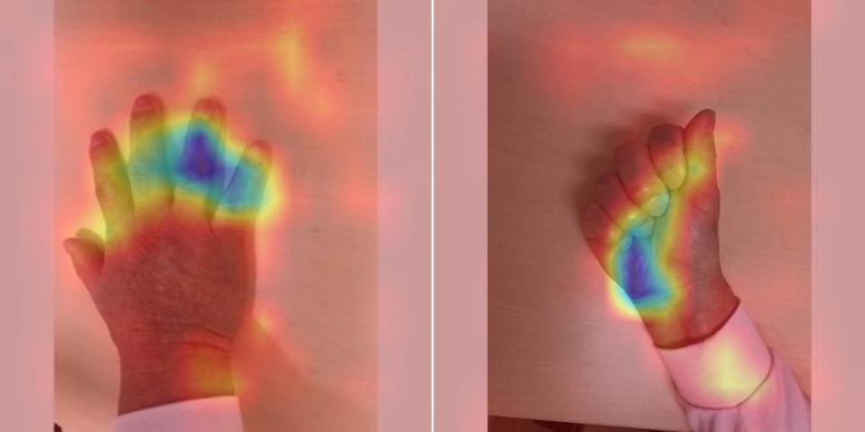 AI Hand Images Diagnose Acromegaly