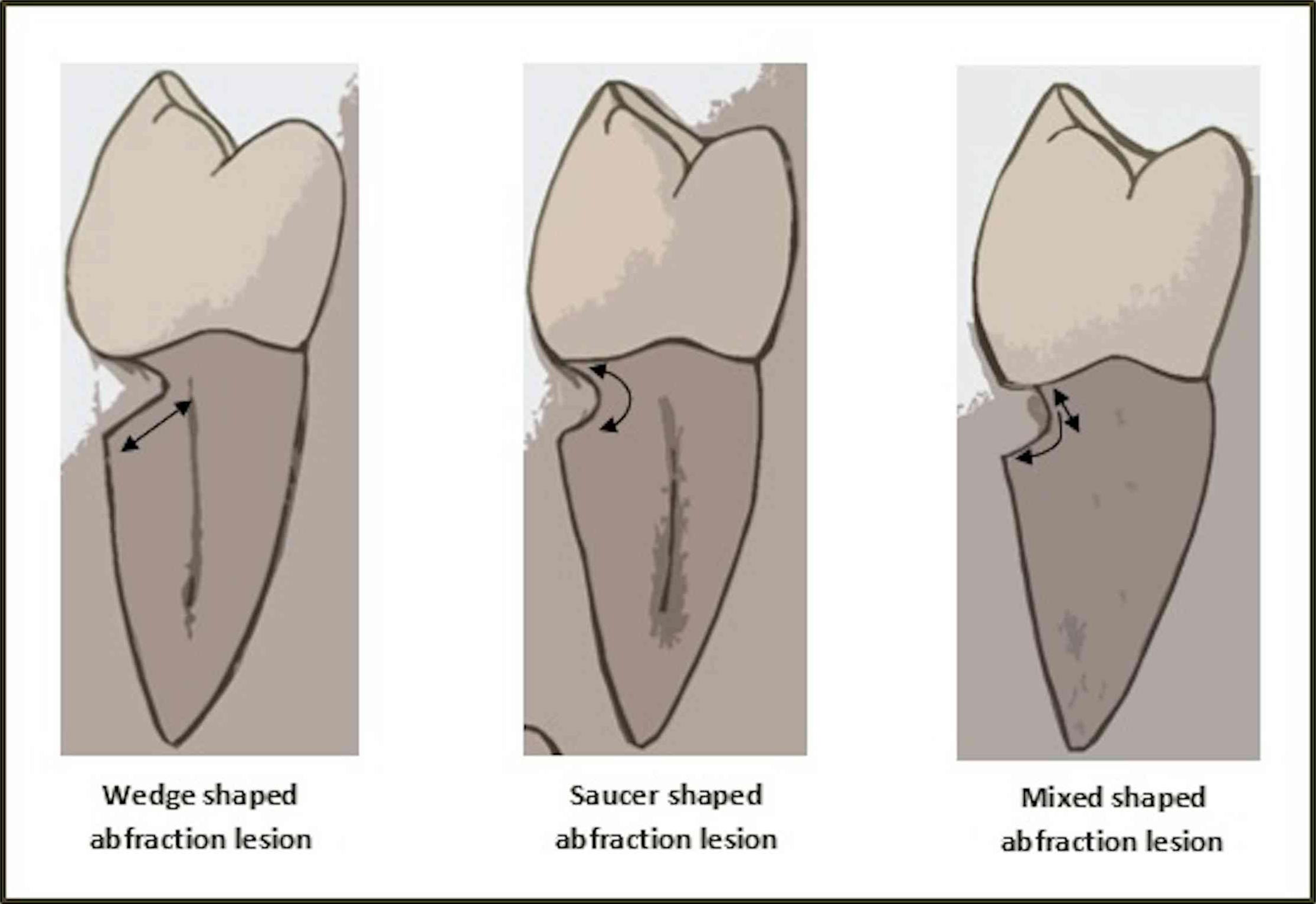 Abfraction Lesions in Modern Human Teeth