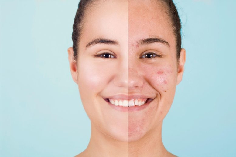 Acne Before And After