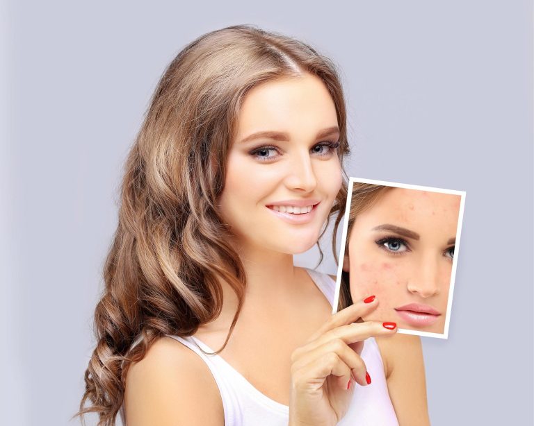 3 Vitamins That Fade Acne Scars Fast