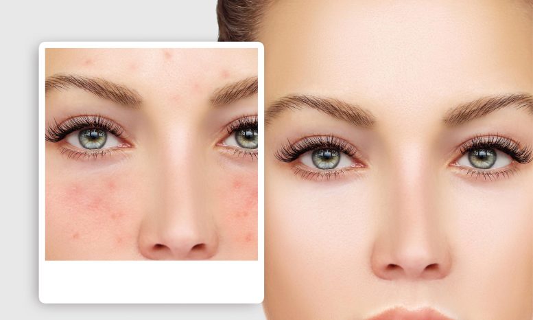 Acne vs Clear Skin
