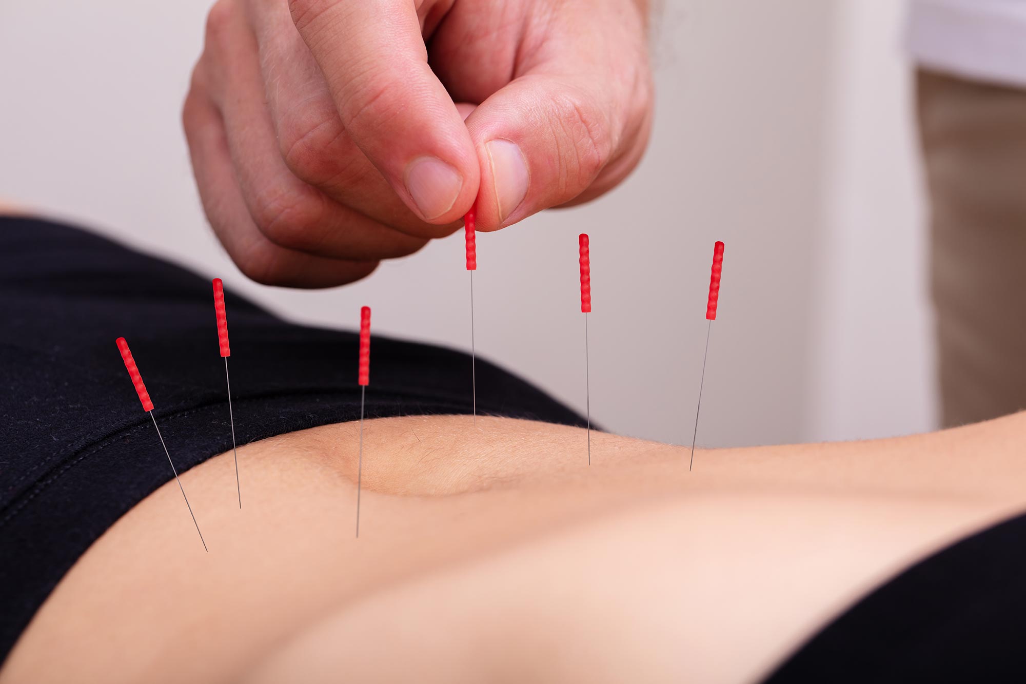 Acupuncture Treatment Belly