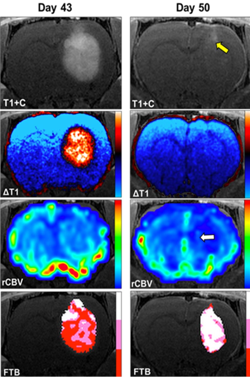 Advanced MRI Brain Cancer Tumor