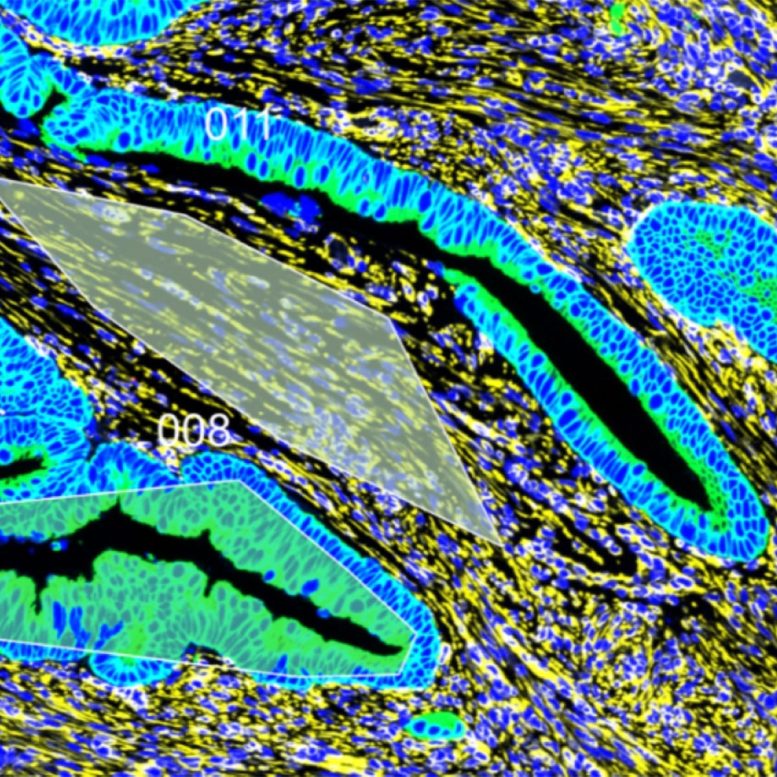 Aligned Fibroblasts Near Early Onset Tumor
