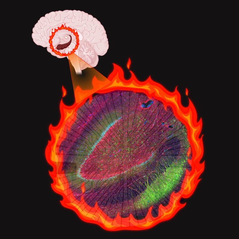 Altered Cells Create an Electrical “Fire” in patients With Epilepsy