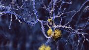 Alzheimer Disease Neurons With Amyloid Plaques