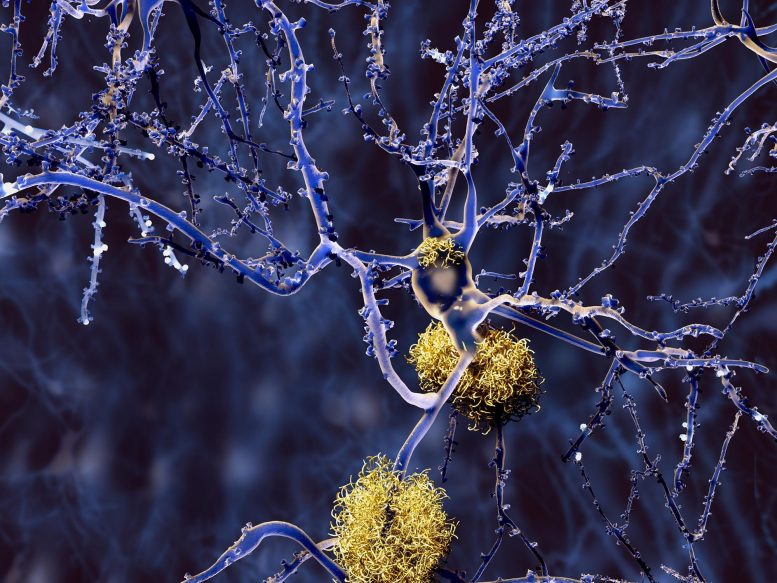 Alzheimer Disease Neurons With Amyloid Plaques