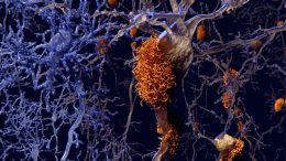 Alzheimers Brain Nerve Cells