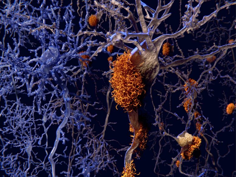 Alzheimers Brain Nerve Cells