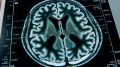 Alzheimer's Brain Scan Art Concept
