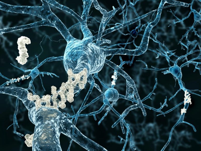 Alzheimer's Disease Neuron Amyloid Plaques