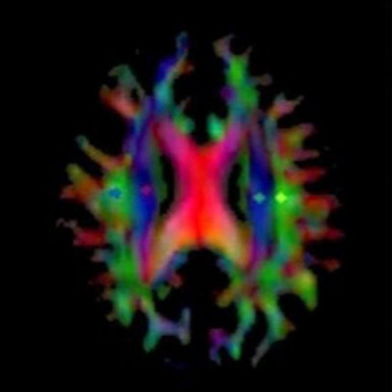 Alzheimer's Patient's Brain Map Glymphatic Flow