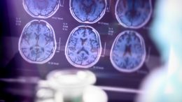Alzheimers Protein Brain Scans