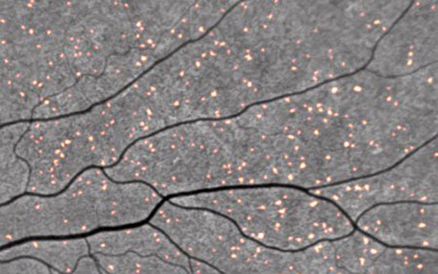 Amyloid Deposits Retinal Scan