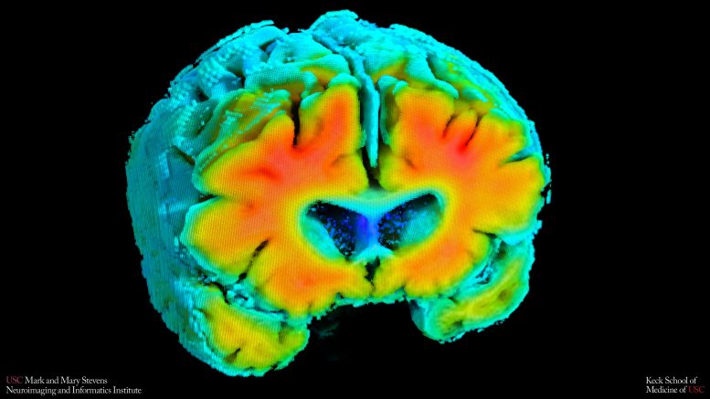 Amyloid PET Brain Scan