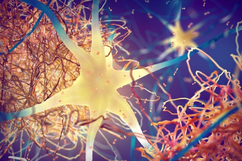 Amyloid Plaques Forming Between Brain Neurons