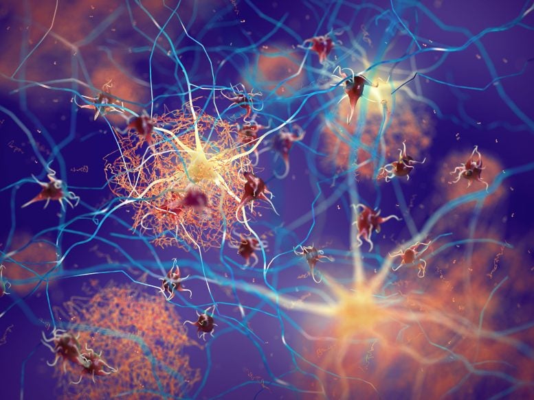 Amyloid Plaques Neurons Alzheimer's Dementia