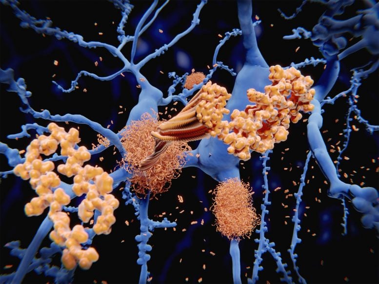 Amyloid Protein Clumps Along Neurons