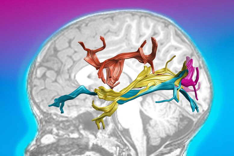 Anatomical Changes in the Brains of the Newly Sighted