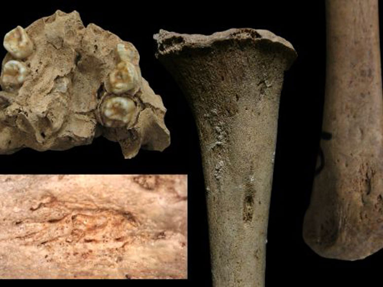 Ancient Bones With Congenital Treponematosis
