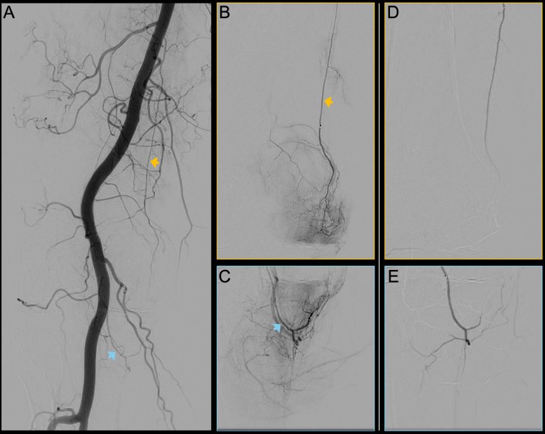 Angiography Images of the Right Knee Joint