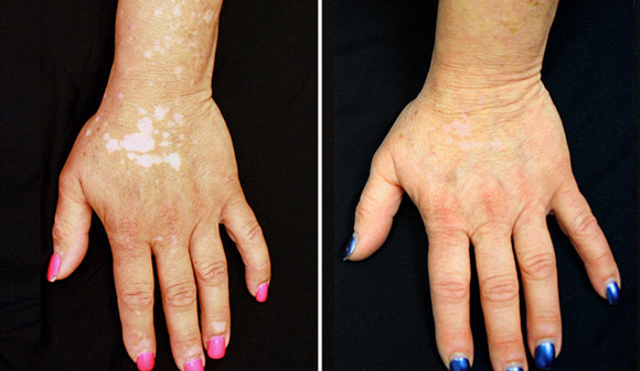 Arthritis Drug Restores Skin Color in Vitiligo Patients
