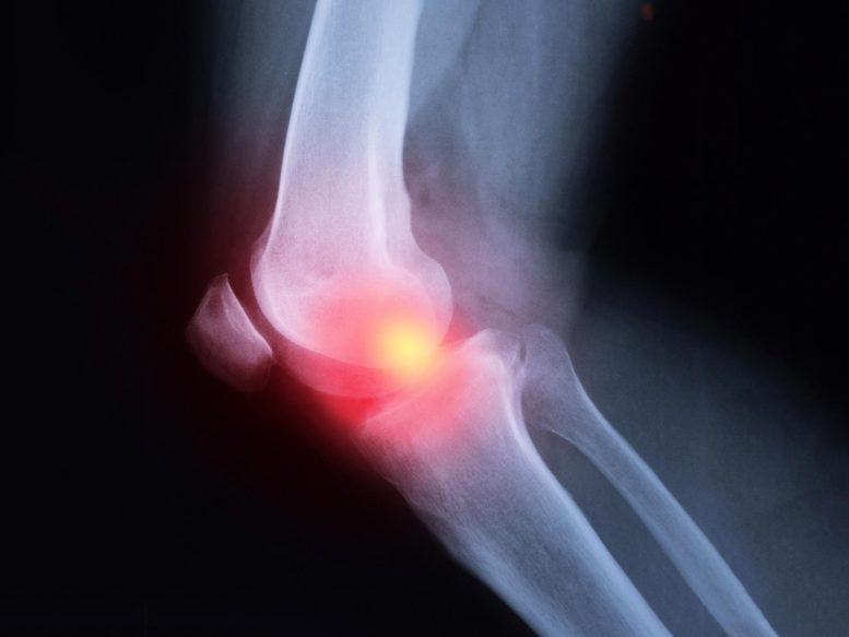 Arthritis Knee Pain X-ray Illustration