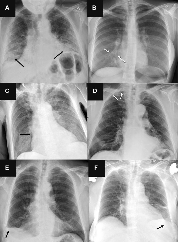 Artificial Intelligence Tools Representative Chest Radiographs in Six Patients