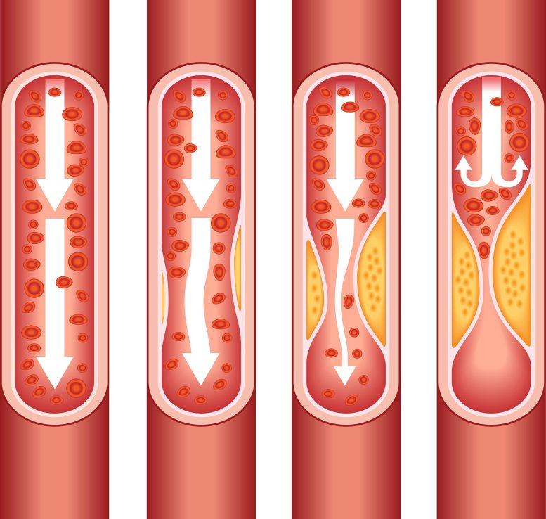 Atherosclerosis Plaque Builds Up in Arteries