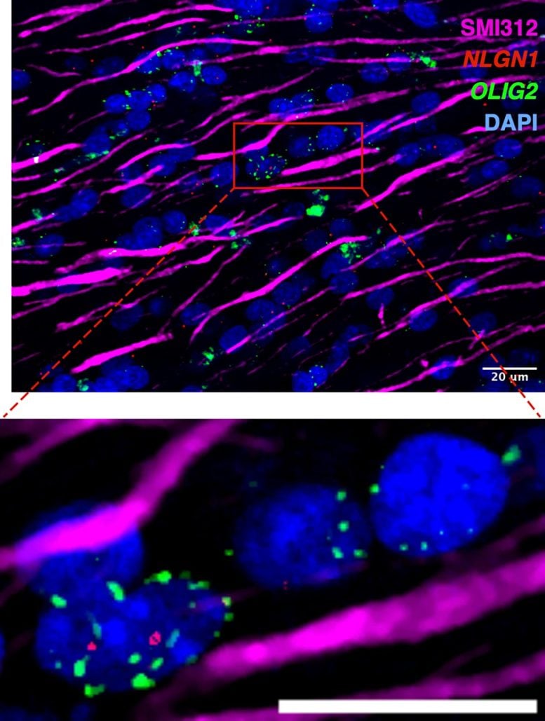 Fibre nervose assonali circondate da cellule cerebrali di supporto