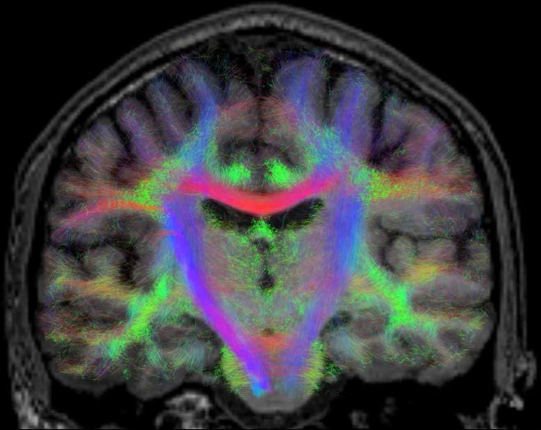 BRAIN DTI Experiment MRI Brain Scan