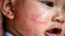 Baby Eczema Rash Allergy Skin