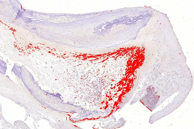 Serangan jantung mungkin menular dan vaksin dapat mencegahnya 1 Bakteri Biofilm Lapisan plak arteri koroner