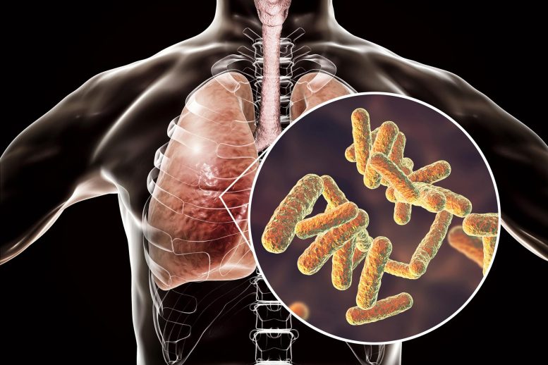 Bacterial Pneumonia Human Lungs