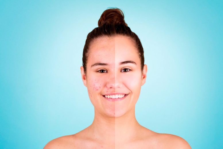 Before And After Acne Treatment