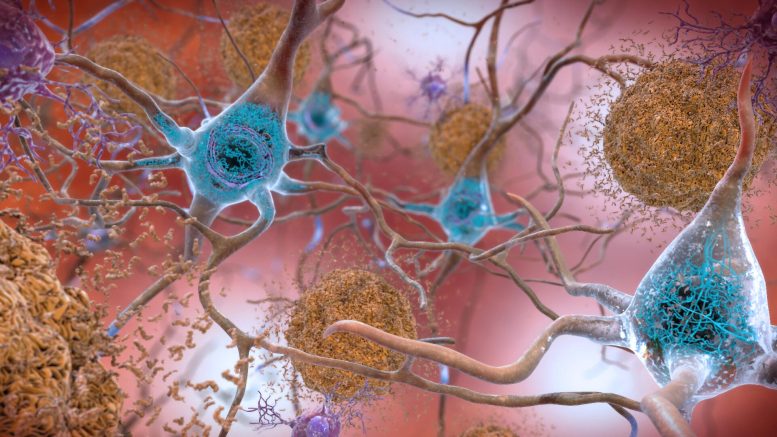 Beta-Amyloid Protein in the Brain Form Plaques