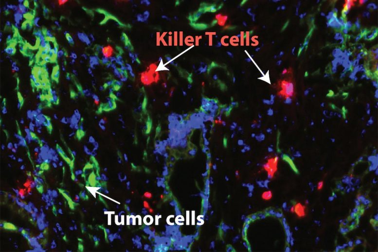 Blocking Major Inflammatory Pathway in Pancreatic Cancer