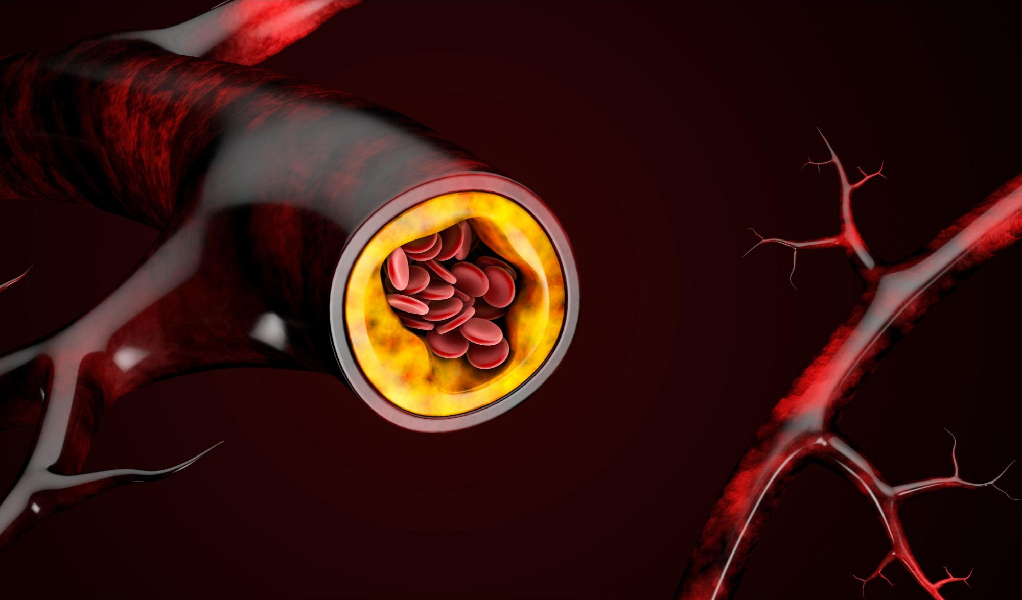 Blood Cells Cholesterol Accumulation