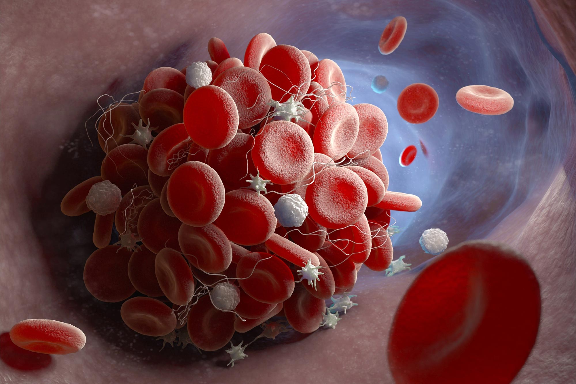 Innovative Treatment Prevents Blood Clots Without Increased Bleeding