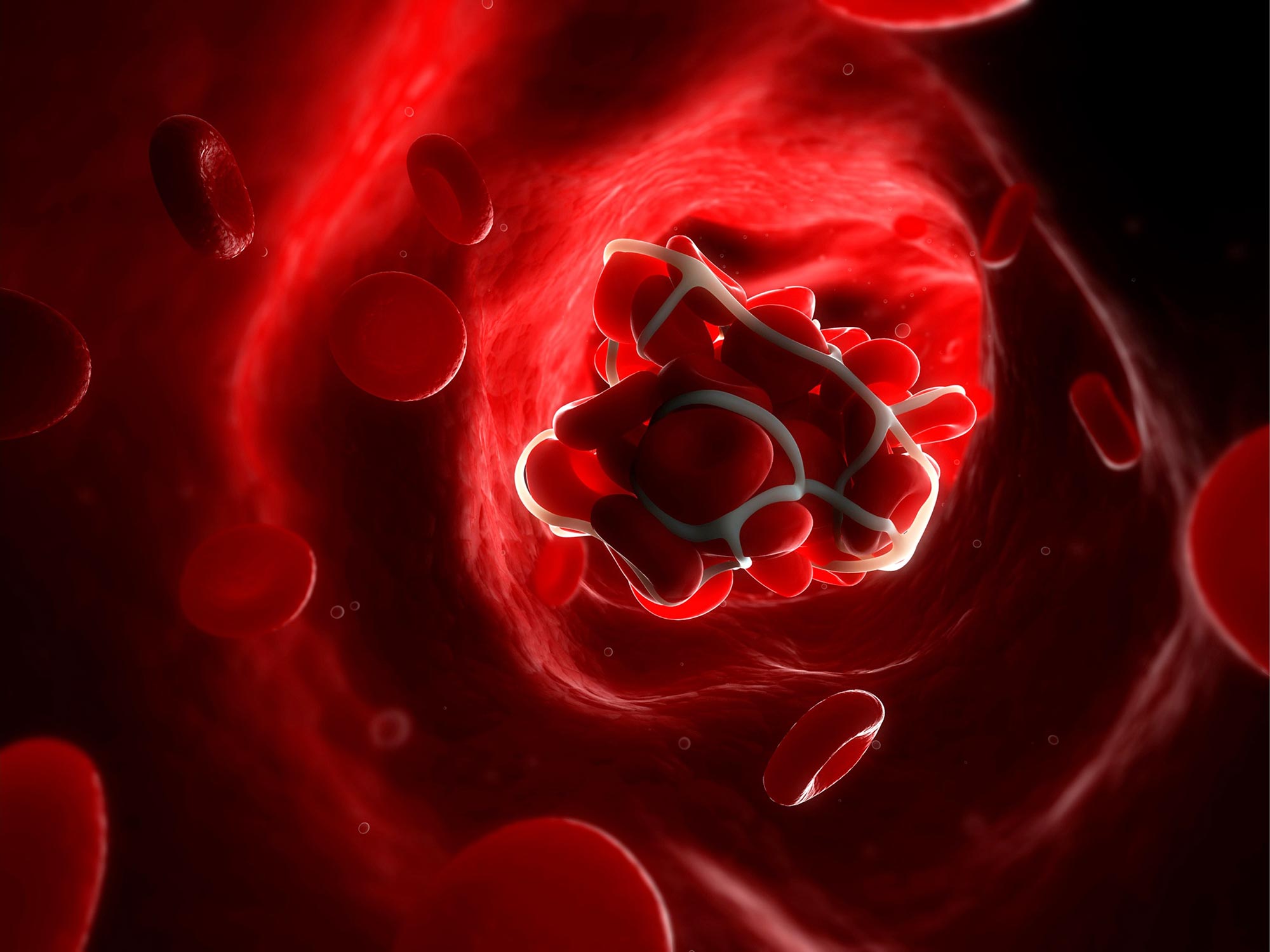 Overload Of Inflammatory Molecules “trapped” In Micro Blood Clots May