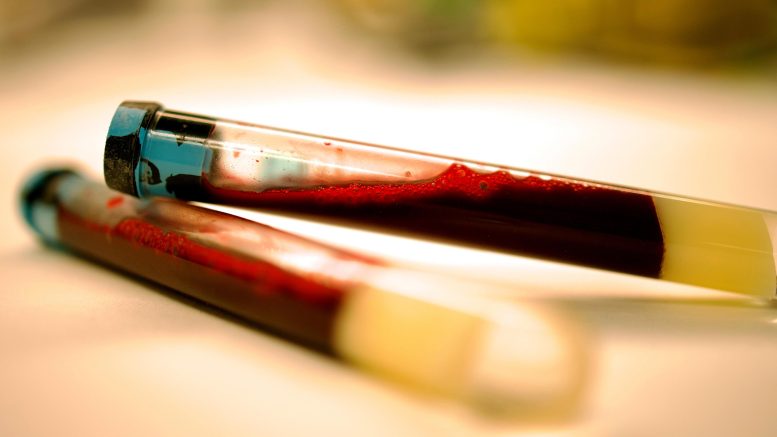 Blood Sample Parkinson's Test