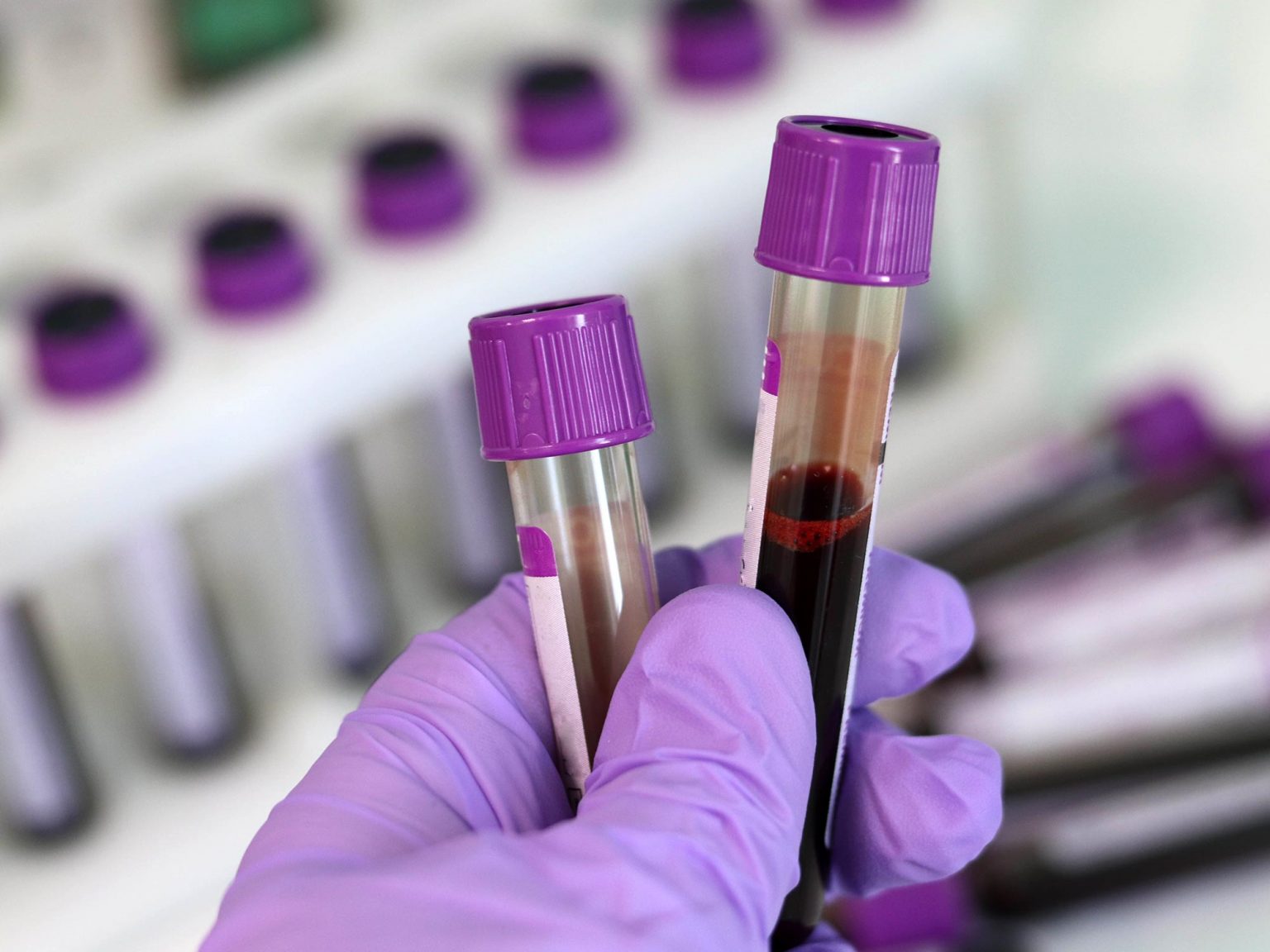 El cancer se puede detectar con analisis de sangre