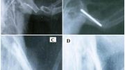 Bone Pin Treatment for Pigeon Wing Fracture